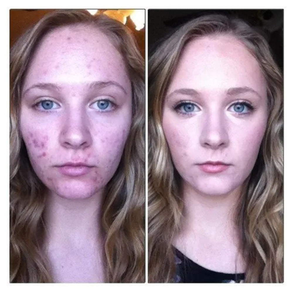 Mascarilla Velo Antiacne bioaqua